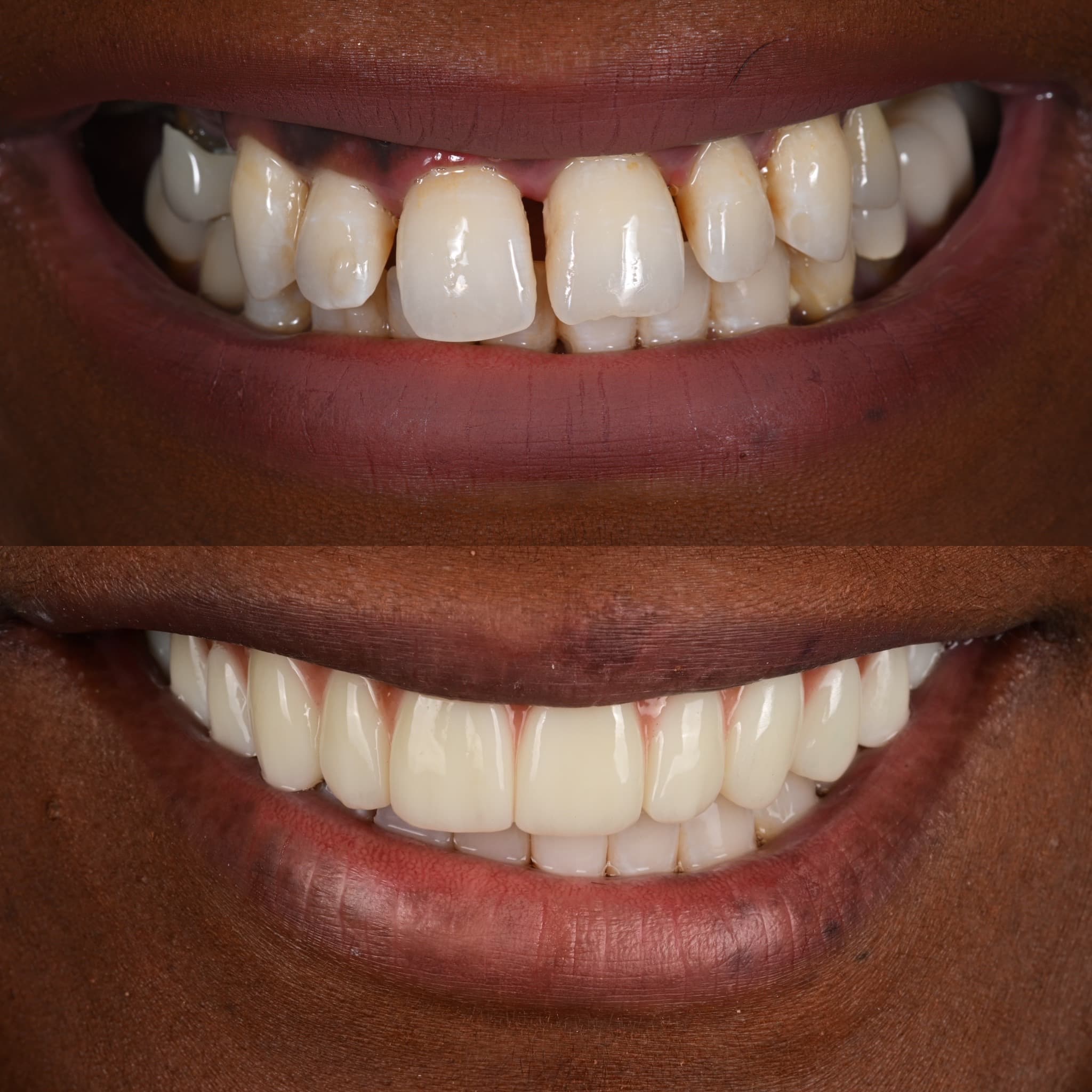 Porcelain Veneers before and after
