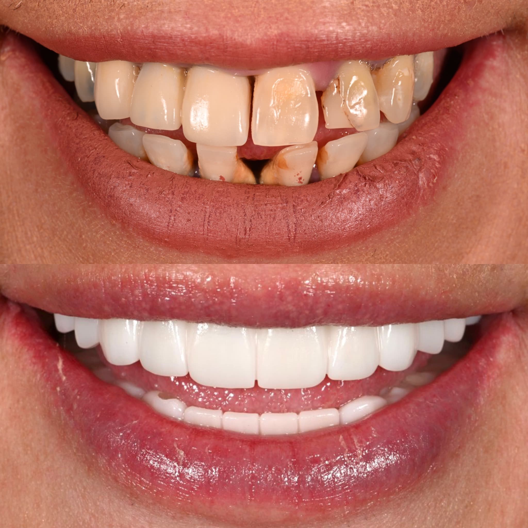 Full Smile Restoration before and after